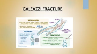 GALEAZZI FRACTURE
 