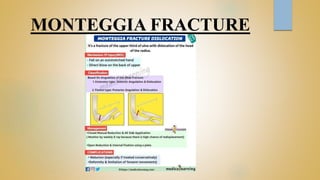 MONTEGGIA FRACTURE
 