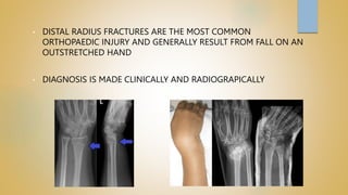 • DISTAL RADIUS FRACTURES ARE THE MOST COMMON
ORTHOPAEDIC INJURY AND GENERALLY RESULT FROM FALL ON AN
OUTSTRETCHED HAND
• DIAGNOSIS IS MADE CLINICALLY AND RADIOGRAPICALLY
 