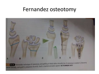 Fernandez osteotomy
 