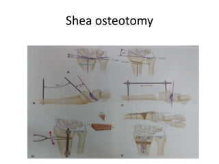 Shea osteotomy
 