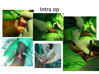 Intra op
 