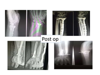 Post op
 