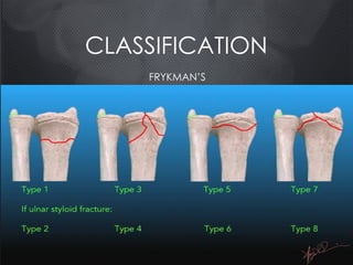 CLASSIFICATION
FRYKMAN’S
 