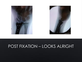 POST FIXATION – LOOKS ALRIGHT
 