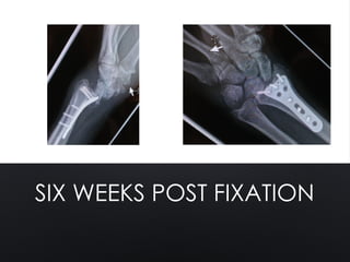 SIX WEEKS POST FIXATION
 