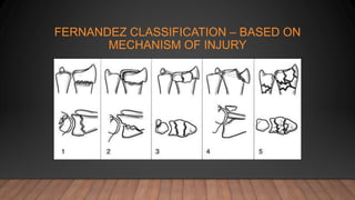 FERNANDEZ CLASSIFICATION – BASED ON
MECHANISM OF INJURY
 