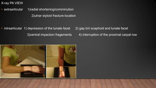 X-ray PA VIEW
• extraarticular 1)radial shortening/comminution
2)ulnar styloid fracture location
• intraarticular 1) depression of the lunate facet 2) gap b/n scaphoid and lunate facet
3)central impaction fragements 4) interruption of the proximal carpal row
 