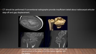 • CT should be performed if conventional radiographs provide insufficient detail about radiocarpal articular
step-off and gap displacement.
communitive intraarticular fracture of the distal radius with
displacement of the volar rim of the radius together with
the carpus
 