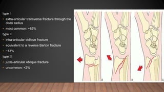 type I
• extra-articular transverse fracture through the
distal radius
• most common: ~85%
type II
• intra-articular oblique fracture
• equivalent to a reverse Barton fracture
• ~13%
type III
• juxta-articular oblique fracture
• uncommon: <2%
 