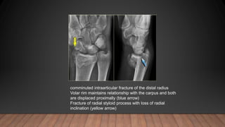 comminuted intraarticular fracture of the distal radius
Volar rim maintains relationship with the carpus and both
are displaced proximally (blue arrow)
Fracture of radial styloid process with loss of radial
inclination (yellow arrow)
 