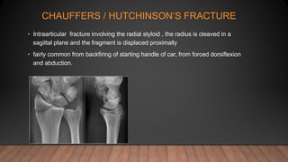 CHAUFFERS / HUTCHINSON’S FRACTURE
• Intraarticular fracture involving the radial styloid , the radius is cleaved in a
sagittal plane and the fragment is displaced proximally
• fairly common from backfiring of starting handle of car, from forced dorsiflexion
and abduction.
 