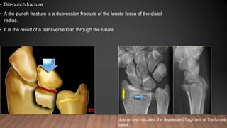 • Die-punch fracture
• A die-punch fracture is a depression fracture of the lunate fossa of the distal
radius.
• It is the result of a transverse load through the lunate
blue arrow indicates the depressed fragment of the lunate
fossa.
 