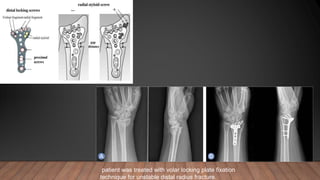 patient was treated with volar locking plate fixation
technique for unstable distal radius fracture.
 