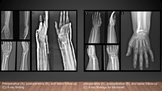 preoperative (A), postoperative (B), and latest follow-up
(C) X-ray findings for Micronail.
Preoperative (A), postoperative (B), and latest follow-up
(C) X-ray finding
 