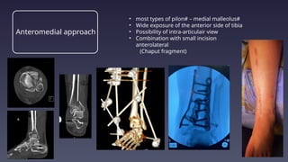 distal tibia and fibula surgical approaches | PPTX