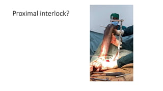 Proximal interlock?
 