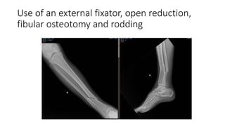 Use of an external fixator, open reduction,
fibular osteotomy and rodding
 