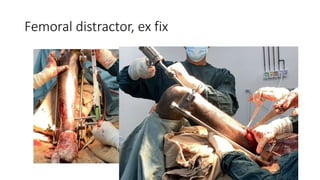 Femoral distractor, ex fix
 