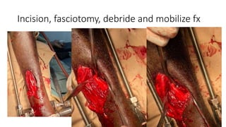 Incision, fasciotomy, debride and mobilize fx
 