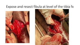 Expose and resect fibula at level of the tibia fx
 