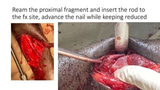 Ream the proximal fragment and insert the rod to
the fx site, advance the nail while keeping reduced
 