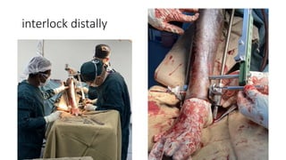 interlock distally
 