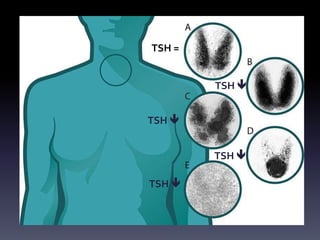 Distiroidismi e rischio cardiovascolare | PPTX