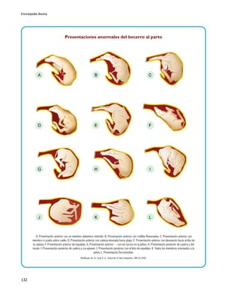 Enciclopedia Bovina

Presentaciones anormales del becerro al parto

A. Presentación anterior con un miembro delantero retenido. B. Presentación anterior con rodillas flexionadas. C. Presentación anterior con
miembro cruzado sobre cuello. D. Presentación anterior con cabeza desviada hacia abajo. E. Presentación anterior con desviación hacia arriba de
la cabeza. F. Presentación anterior de espaldas. G. Presentación anterior —con los tarsos en la pelvis. H. Presentación posterior de cadera y del
muslo. I. Presentación posterior de cadera y corvejones. J. Presentación posterior con el feto de espaldas. K. Todos los miembros orientados a la
pelvis. L. Presentación Dorsolumbar.
Modificado de: Dr. Cady R. A., University of New Hampshire. IRM-20.2000.

132

 