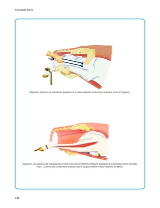 Enciclopedia Bovina

Diagnóstico: Extracción por embriotomía. Amputación de la cabeza utilizando el embriotomo de alambre (sierra de Thygesen)..

Diagnóstico: Las cabeza ha sido rechazada hacia el útero. Extracción por fetotomía. Extirpación subcutánea de la extremidad anterior extendida.
Fase 1. La piel ha sido cortada desde la pezuña hasta la escápula mediante el bisturí obstétrico de Roberts.

136

 