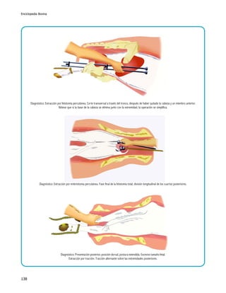 Enciclopedia Bovina

Diagnóstico: Extracción por fetotomía percutánea. Corte transversal a través del tronco, después de haber quitado la cabeza y un miembro anterior.
Nótese que si la base de la cabeza se elimina junto con la extremidad, la operación se simplifica.

Diagnóstico: Extracción por embriotomía percutánea. Fase final de la fetotomía total; división longitudinal de los cuartos posteriores.

Diagnóstico: Presentación posterior, posición dorsal, postura extendida. Excesivo tamaño fetal.
Extracción por tracción. Tracción alternante sobre las extremidades posteriores.

138

 