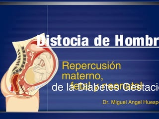 Distocia de Hombr
    Repercusión
    materno,
      fetal y neonatal
  de la Diabetes Gestacio
            Dr. Miguel Angel Huespe
 