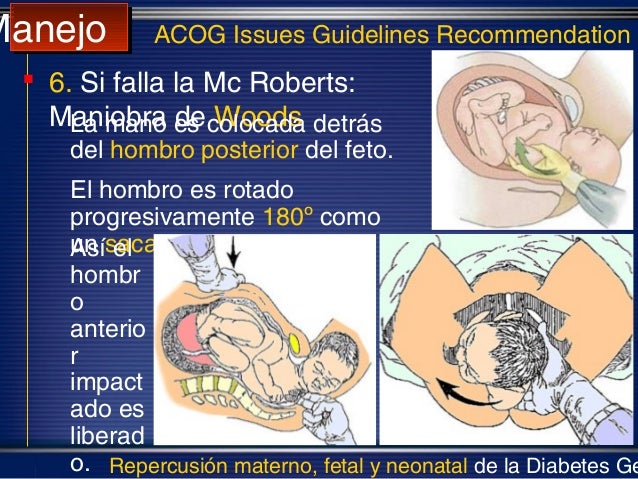 Distocia de hombros clase huespe