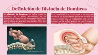 Definición de Distocia de Hombros
La distocia de hombros se define como la
dificultad en la salida espontánea de los
hombros que requiere de maniobras obstétricas
adicionales para producir la expulsión fetal tras
la salida de la cabeza.
Esta complicación se produce por la impactación
de uno o los dos hombros fetales en estructuras
pélvicas maternas. La impactación del hombro
anterior en la sínfisis púbica es más frecuente
que la del hombro posterior en el promontorio
sacro.
 