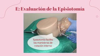 E: Evaluación de la Episiotomía
 