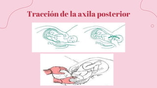 Tracción de la axila posterior
 