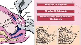 Maniobra de Zavanelli
Cirugía y Sinfisiotomía
Fractura Clavicular deliberada o
Cleidotomía
 