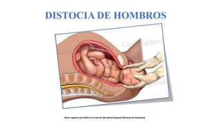 DISTOCIA DE HOMBROS
Parto vaginal con lesión en el nervio del plexo braquial (distocia de hombros)
 