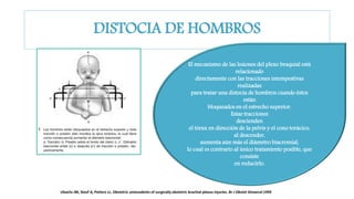 DISTOCIA DE HOMBROS
El mecanismo de las lesiones del plexo braquial está
relacionado
directamente con las tracciones intempestivas
realizadas
para tratar una distocia de hombros cuando éstos
están
bloqueados en el estrecho superior.
Estas tracciones
descienden
el tórax en dirección de la pelvis y el cono torácico,
al descender,
aumenta aún más el diámetro biacromial,
lo cual es contrario al único tratamiento posible, que
consiste
en reducirlo.
Ubachs JM, Sloof A, Petters LL. Obstetric antecedents of surgically obstetric brachial plexus injuries. Br J Obstet Ginaecol 1995
 