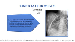 DISTOCIA DE HOMBROS
Morbilidad
Fetal
Mazouni C, Menard JP, Porcu G, Cohen-Solal E, Heckenroth H, Gamerre M, Bretelle F. Maternal morbidity associated with obstetrical maneuvers in shoulder dystocia. Euro J Obstet Gynecol Reprod Bio 2006
 
