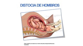 DISTOCIADEHOMBROS
Parto vaginal con lesión en el nervio del plexo braquial (distocia de
hombros)
 