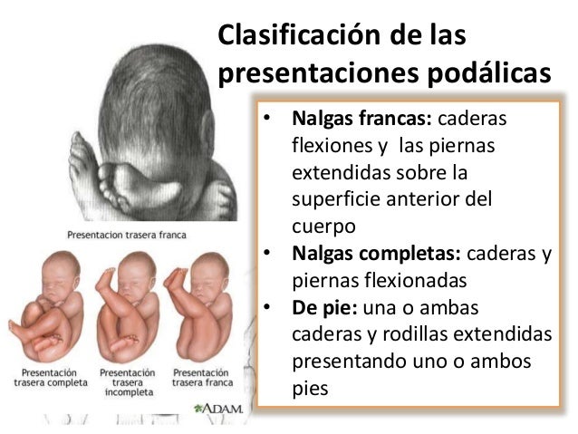 Macrosomia Fetale E Sindrome Di Down