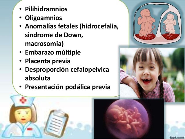 Macrosomia Fetale E Sindrome Di Down
