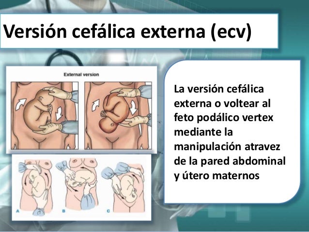 Macrosomia Fetale E Sindrome Di Down