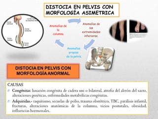 DISTOCIA EN PELVIS CON
MORFOLOGÍA ASIMETRICA
Anomalías de
las
extremidades
inferiores.
Anomalías
propias
de la pelvis.
Anomalías de
la
columna.
 