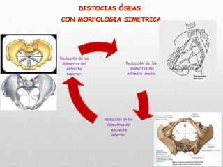 Reducción de los
diámetros del
estrecho medio.
Reducción de los
diámetros del
estrecho
inferior.
Reducción de los
diámetros del
estrecho
superior.
DISTOCIAS ÓSEAS
CON MORFOLOGIA SIMETRICA
9
11
 