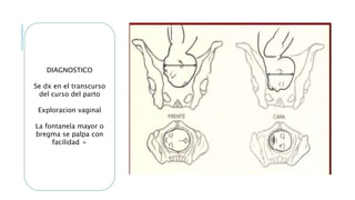 DIAGNOSTICO
Se dx en el transcurso
del curso del parto
Exploracion vaginal
La fontanela mayor o
bregma se palpa con
facilidad +
 