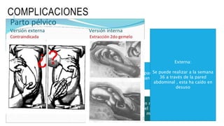 COMPLICACIONES
La situación transversa no suele presentar
complicaciones mayores
Las complicaciones suelen aparecer en el parto
o cuando se produce la rotura de membranas
La complicación mas temida es el prolapso
de cordon en el momento de la rotura de
membranas
Externa:
Se puede realizar a la semana
36 a través de la pared
abdominal , esta ha caído en
desuso
 