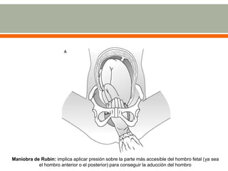 Maniobra de Rubin: implica aplicar presión sobre la parte más accesible del hombro fetal (ya sea
el hombro anterior o el posterior) para conseguir la aducción del hombro
 