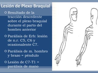  Resultado de la
tracción descedente
sobre el plexo braquial
durante el parto del
hombro anterior
 Parálisis de Erb: lesión
de n.r. C5, C6 y
ocasionalente C7.
 Parálisis de m. hombro
y brazo = péndulo
 Lesión de C7-T1 =
parálisis de mano
 